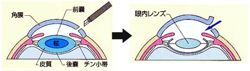 白内障手術による隅角の改善