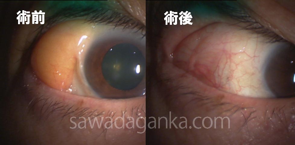 眼窩脂肪ヘルニア 両眼