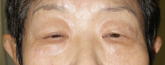 眼瞼下垂 術前