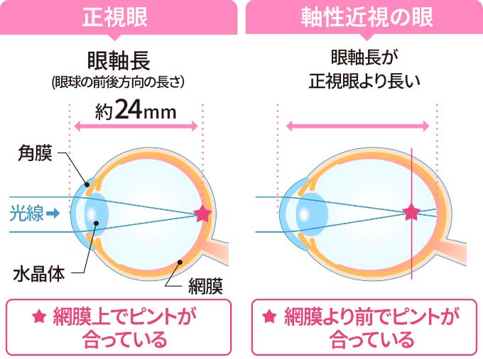 正視眼と軸性近視の眼の比較