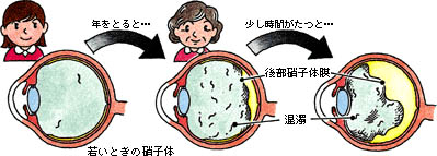 後部硝子体剥離