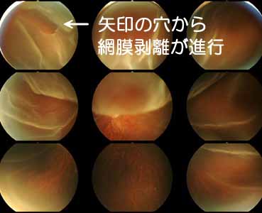 網膜剥離