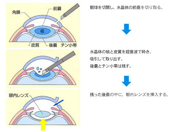 後発白内障の模式図