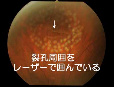 網膜裂孔