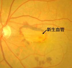 黄斑変性　眼底写真　さわだ眼科